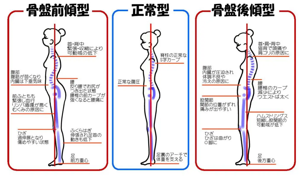 人の姿勢は正常型と比べると骨盤前傾型、骨盤後傾型は姿勢の歪みによって様々な症状が現れやすくなる