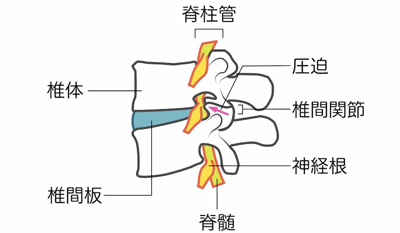 椎間関節