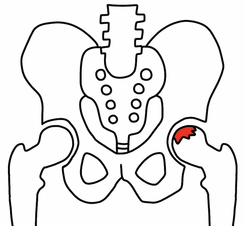 大腿骨頭壊死