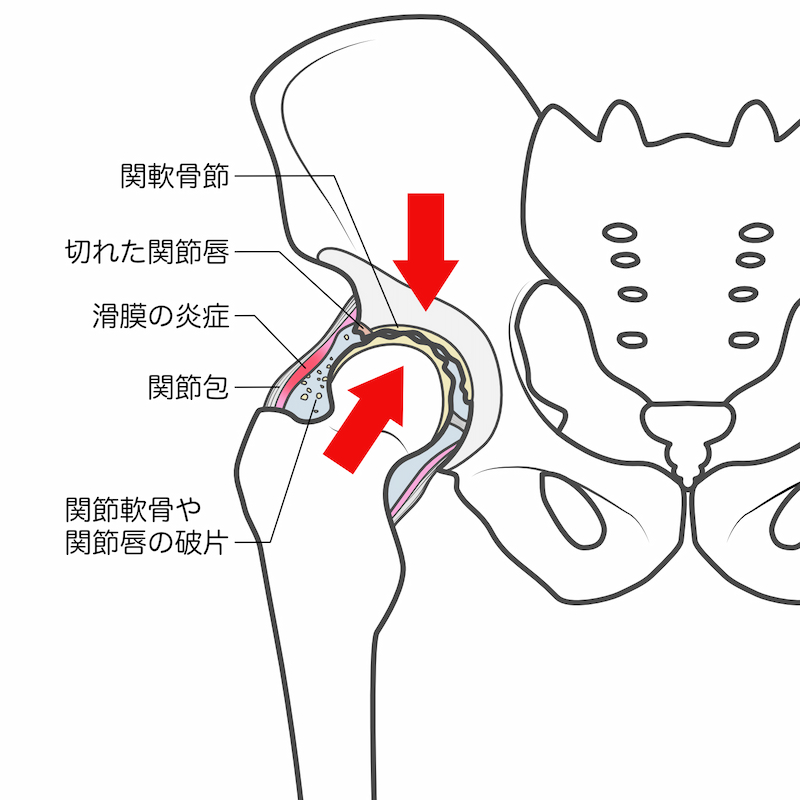 変形性股関節症