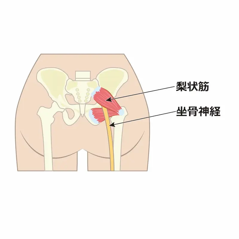 筋肉の圧迫によって神経痛が発生している