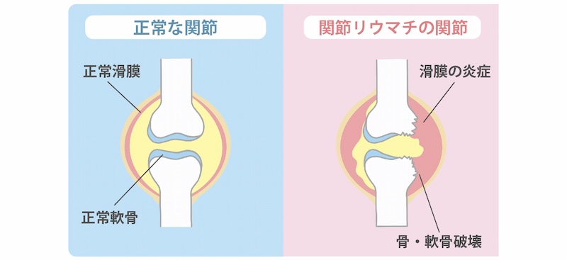 関節リウマチ