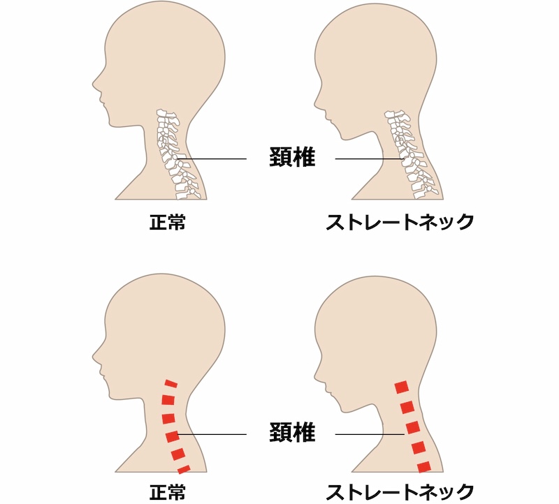 ストレートネック