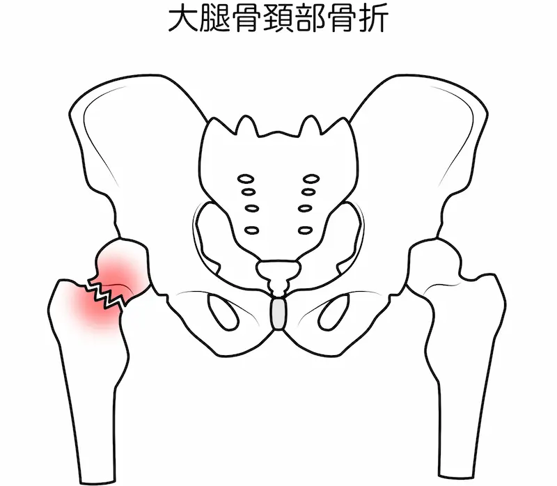大腿骨頚部骨折